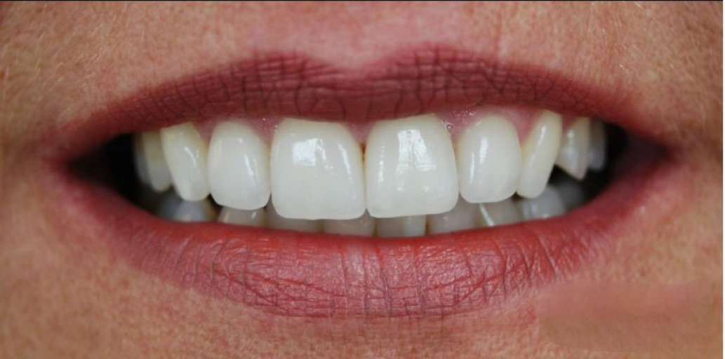 teeth After Veneer treatments