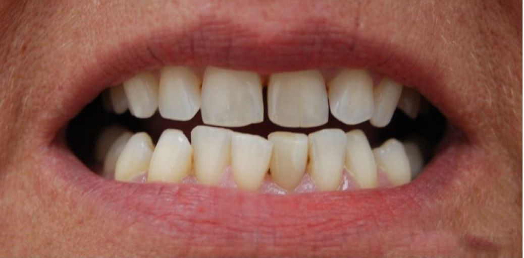 teeth before Veneer treatments