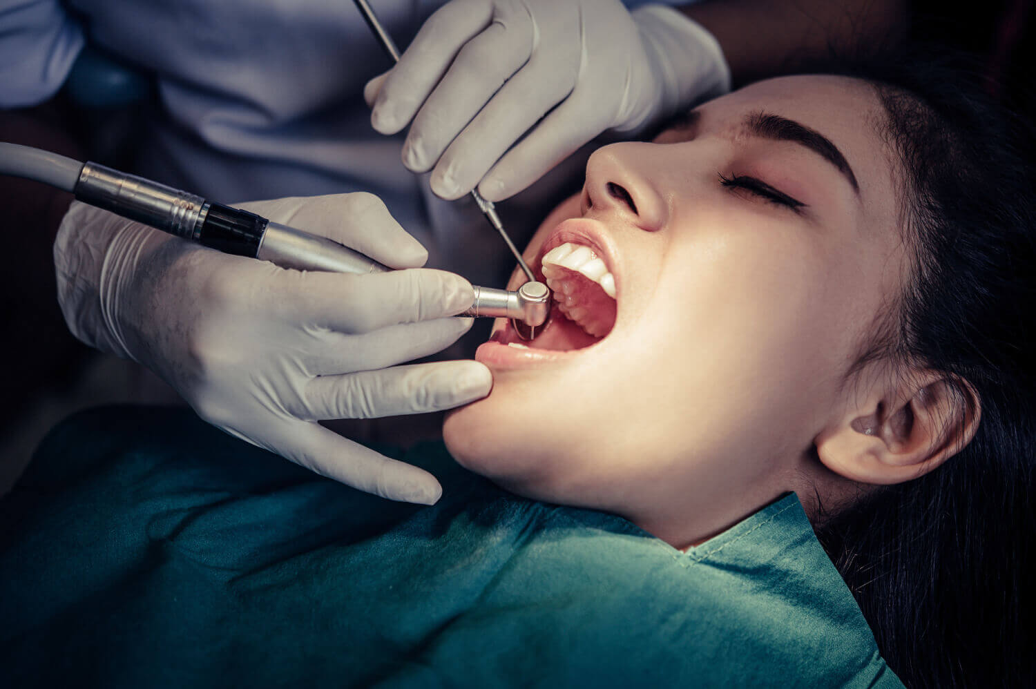 tooth fillings